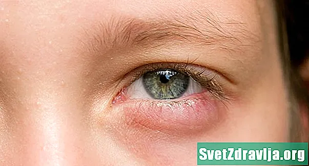 10 causas de inchaço sob os olhos