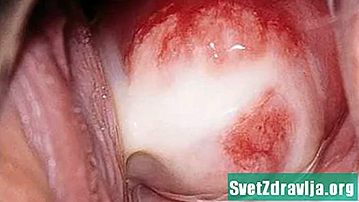 6 causes de brûlures non MST à la pointe de l'urètre - Santé