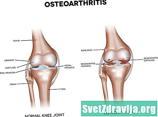 6 Osteoarthritis (OA) korai tünetei: fájdalom, érzékenység és így tovább - Egészség
