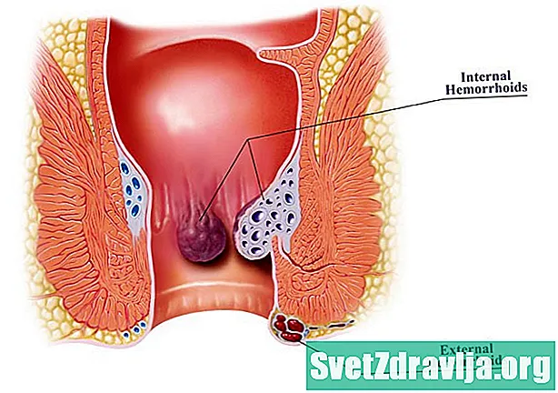 7 Možné príčiny bolesti Anus