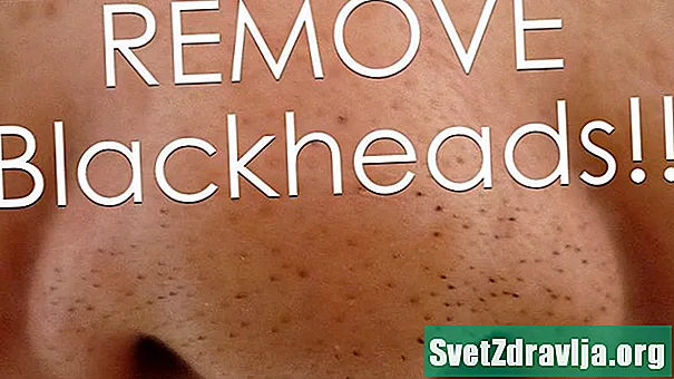 8 způsobů, jak odstranit Blackheads z nosu, Plus Prevention Tipy