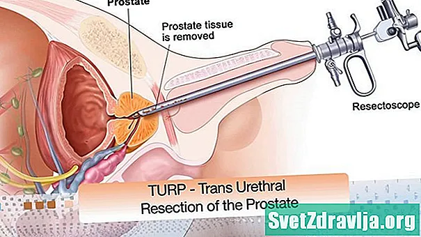 Sprievodca po tlačidle TURP pre zväčšenú prostatu - Zdravie