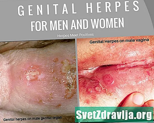 Ein Leitfaden zu Herpes genitalis-Symptomen bei Männern
