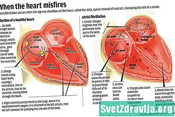 Um olhar sobre a fibrilação atrial paroxística