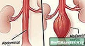 Курсактын аорта аневризмасы - Сулуулук