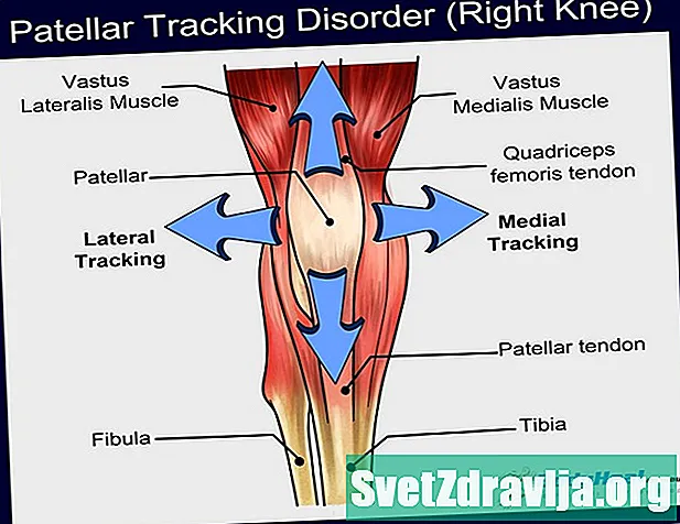 Over Patellar Tracking Disorder