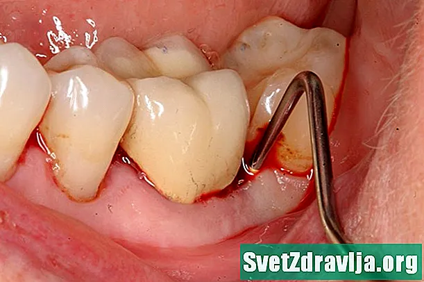 Abszessierter Zahn: Was Sie wissen müssen - Gesundheit