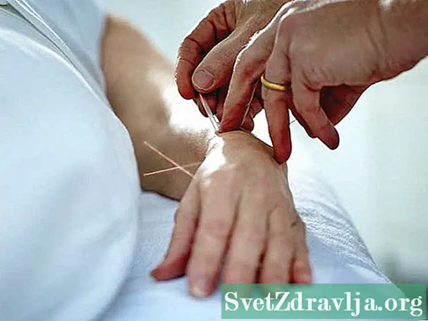 Acupuncture for Neuropathy