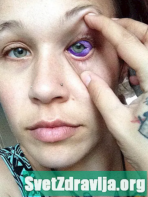 Después de los comentarios sobre la marca de nacimiento de su ojo, este vlogger de belleza da una lección sobre el respeto - Salud