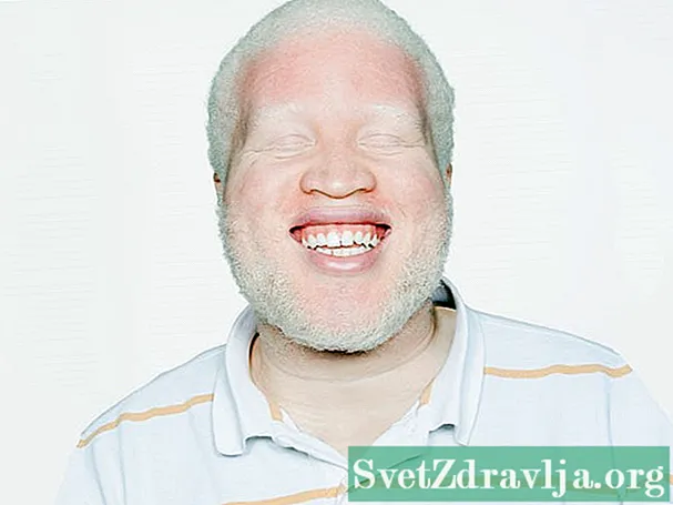 Albinismu