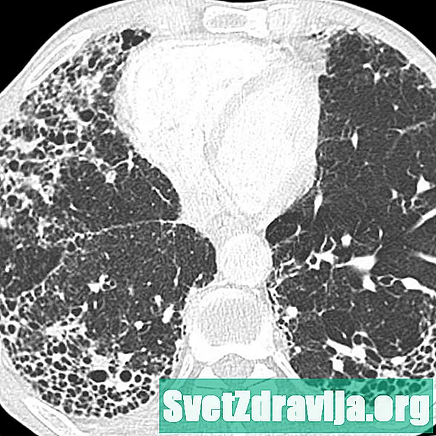 Idiopatik pulmoner fibroz (IPF) alevlenmalari haqida hamma narsa