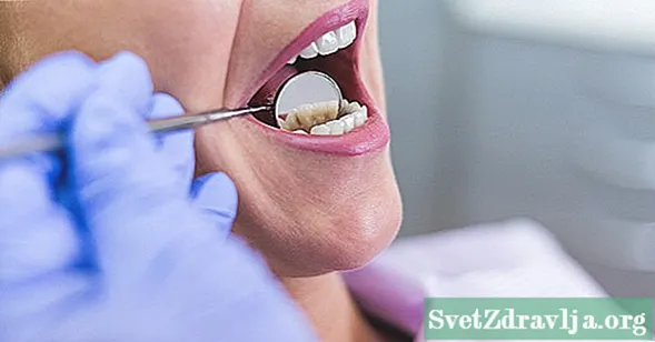 Alla mina tänder skadar plötsligt: ​​10 möjliga förklaringar - Wellness