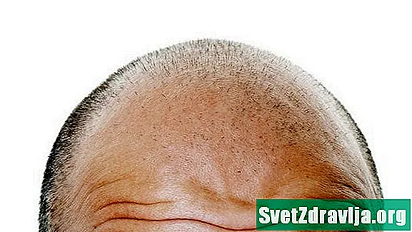 脱毛症Barbae：あなたのひげの白斑を治療する方法 - 健康