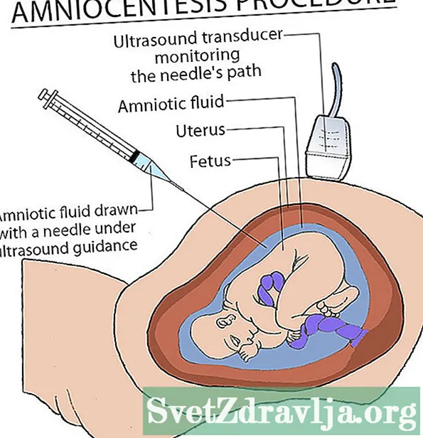 Amniocentēze