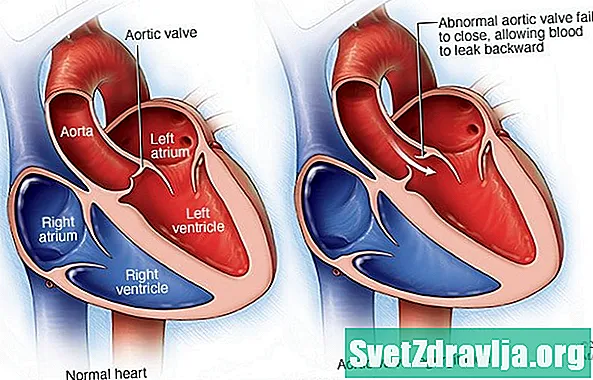 Aortan venttiilin riittämättömyys - Terveys