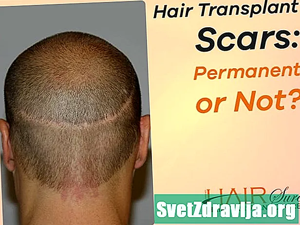 Les cicatrices de greffe de cheveux sont-elles permanentes ou peuvent-elles être enlevées? - Santé