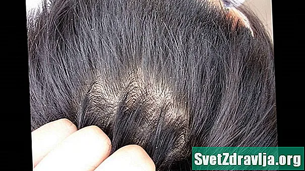 Izogibanje izpadanju las zaradi prhljaja - Zdravje