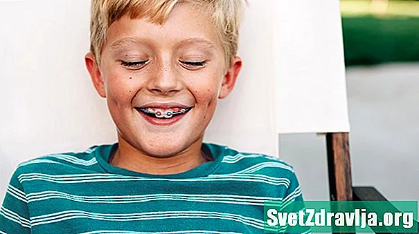 Najlepšie spôsoby, ako udržať zuby biele pri nosení rovnátka - Zdravie