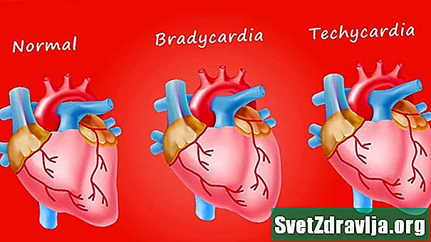 Bradycardia (lassú pulzusszám) - Egészség