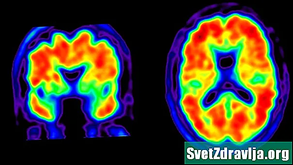 Мозъчен PET сканиране