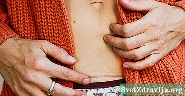 Cicatrices de cesárea: qué esperar durante y después de la curación