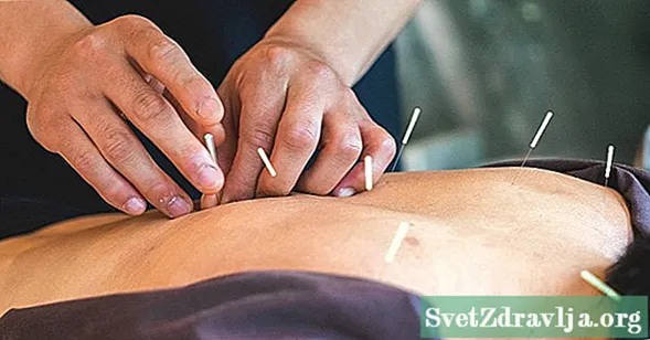 Makatutulong ba ang Acupuncture na Tratuhin ang Aking Rheumatoid Arthritis?