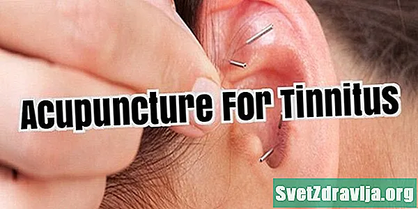 Kan akupunktur hjälpa till med tinnitus?