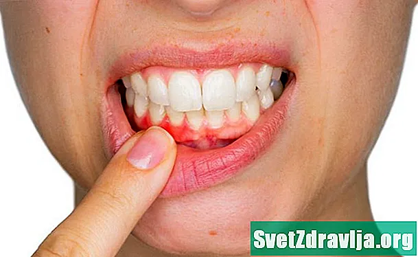 Ar panirimas gali sukelti kraujavimo dantenas?