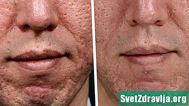 Puc tractar les cicatrius d’acne amb microneedling?