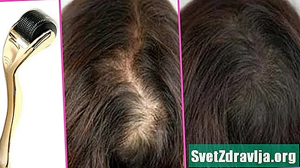 Μπορεί το Scalp Microneedling να αναζωογονήσει τα μαλλιά σας; - Υγεία