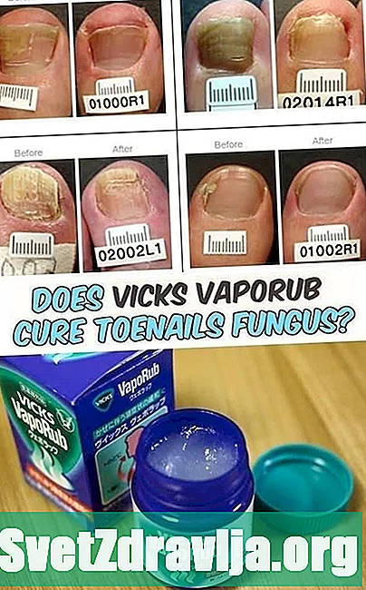 Kan Vicks VapoRub helbrede en ørepine? - Sundhed