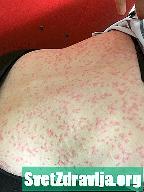 Môžete byť alergickí na bandážové pomôcky a iné adhezívne obväzy?