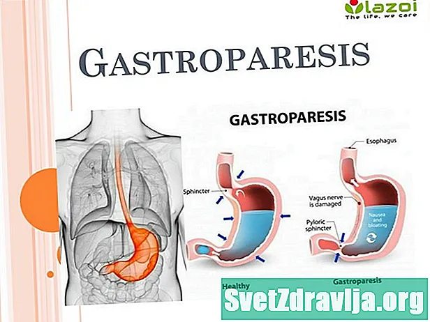 Gastroparesis'ten ölebilir misin? Ve Nasıl Tedavi Edilir - Sağlık