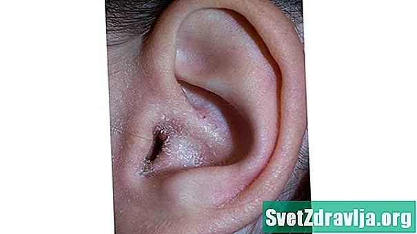 Bạn có thể bị chàm trong tai?
