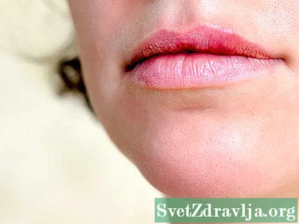 Können Sie Hautmarken auf Ihren Lippen haben? - Wellness