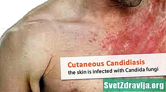 Infekcia kože Candida huba - Zdravie