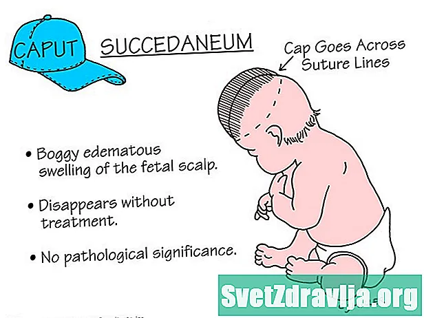 Caput Succedaneum (inchaço do couro cabeludo durante o parto) - Saúde
