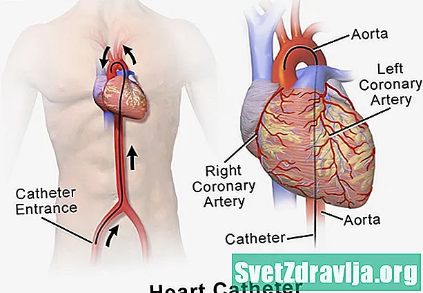 Sydämen katetrointi - Terveys