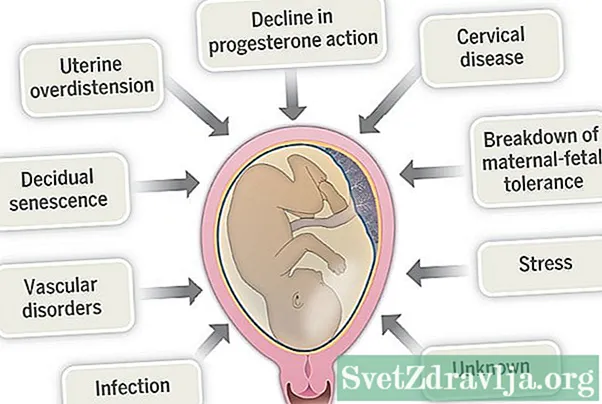 Causes del part prematur: tractament per al coll uterí incompetent