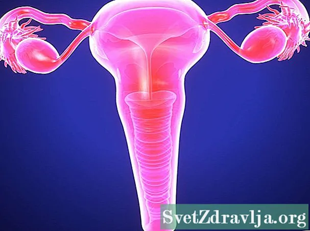 Cervikální endometrióza
