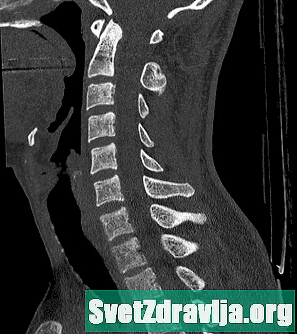 Cervical ryggrad CT-skanning