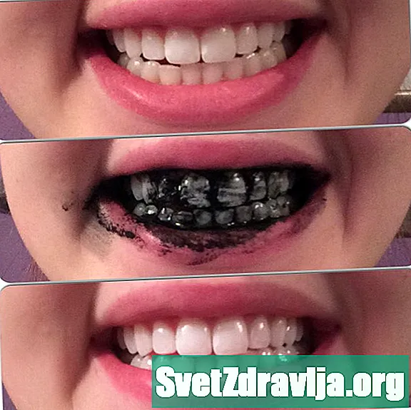 Zubná pasta na uhlie na bielenie zubov: klady a zápory