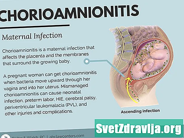 Chorioamnionitis: Impeksyon sa Pagbubuntis