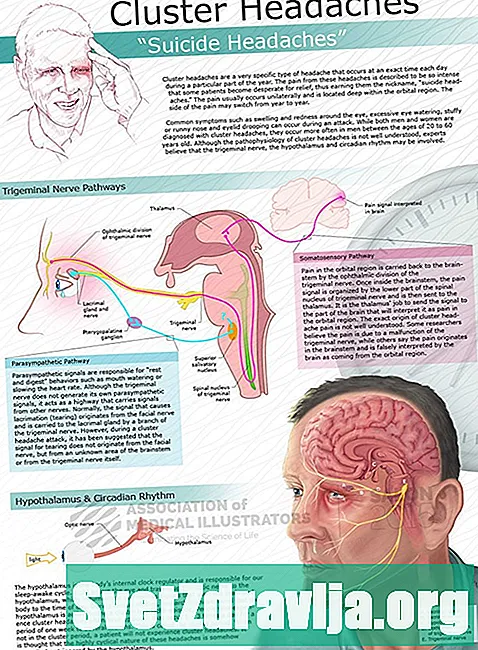Clusterové bolesti hlavy - Zdravie