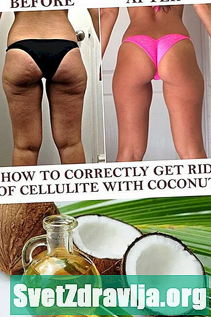 Kokosovo ulje za celulit: djeluje li?