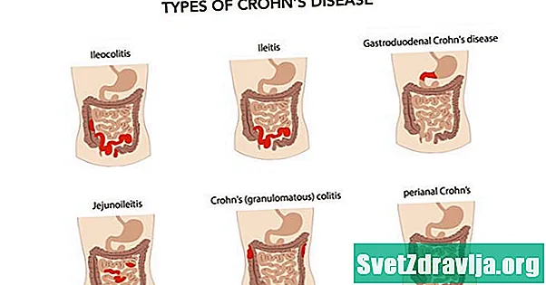 Komplikationer af ubehandlet Crohns sygdom