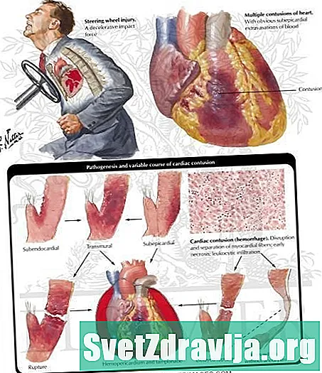 Contusió del cor (contusió miocàrdica)