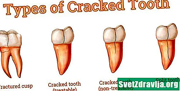 Dhëmb i plasaritur - Shëndetësor