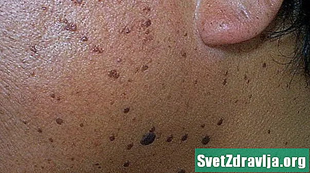 Dermatóza Papulosa Nigra - Zdraví