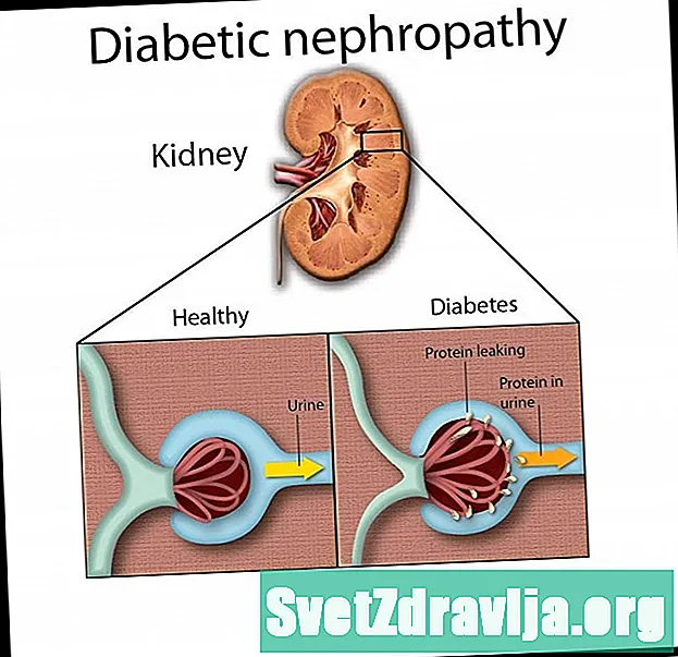 Нефропатии диабетикӣ - Саломатӣ